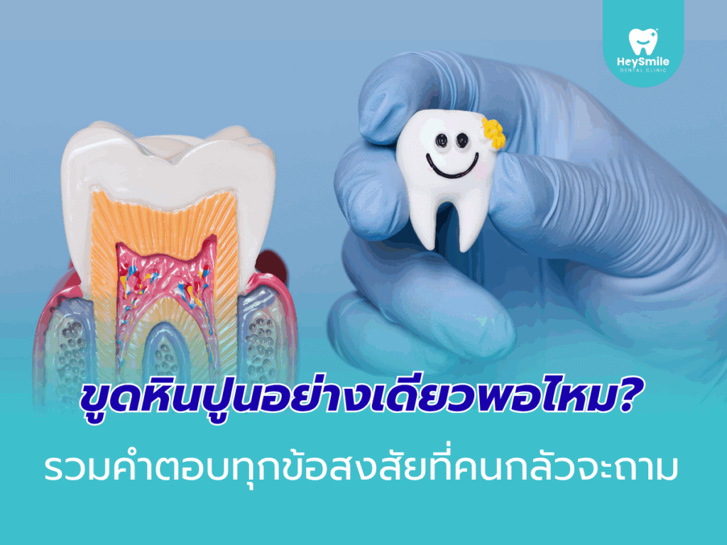 ขูดหินปูน