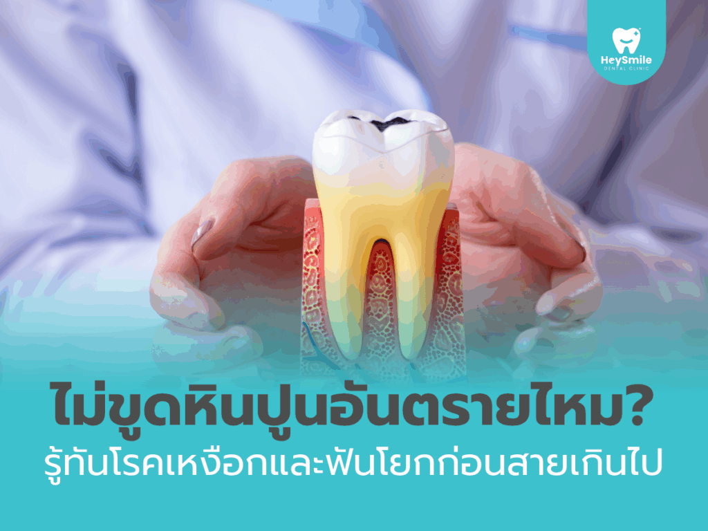 ขูดหินปูน