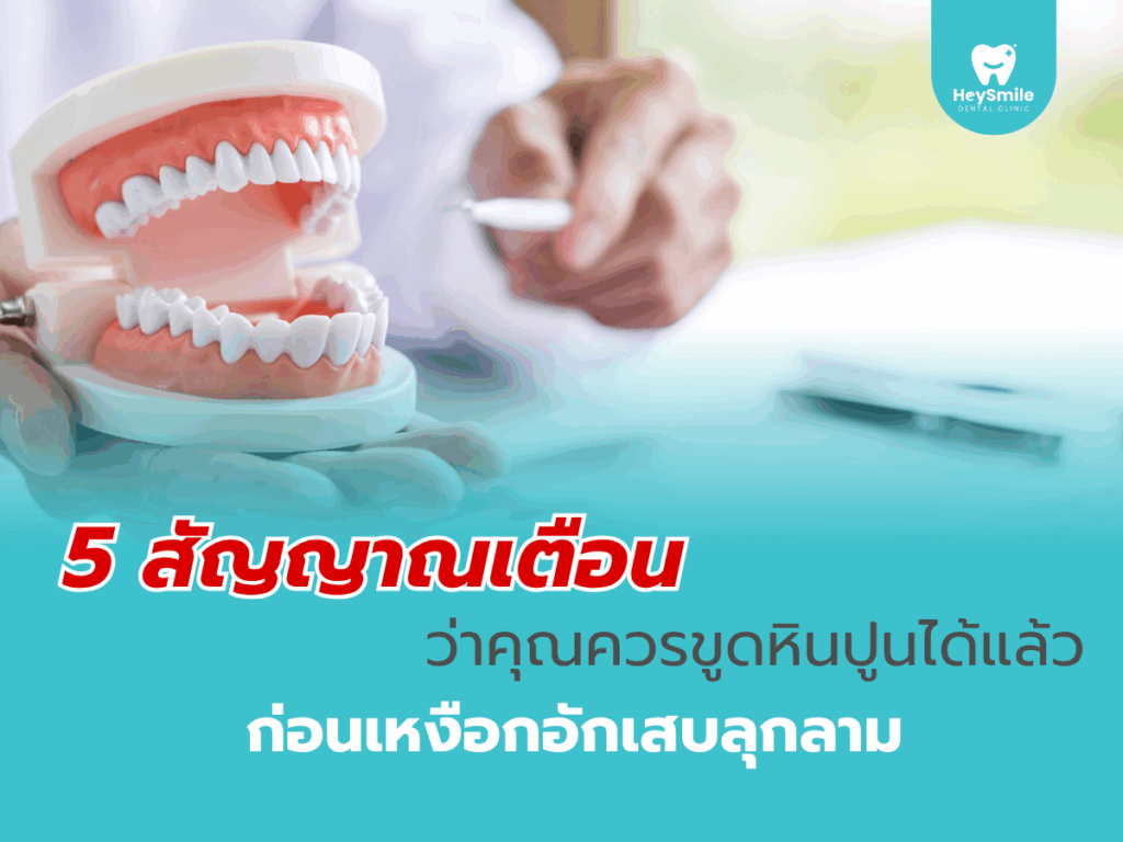 ขูดหินปูน