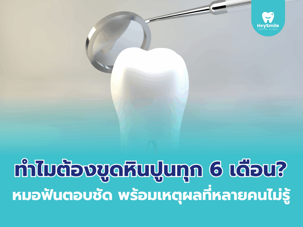 ขูดหินปูน