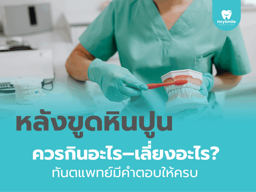 ขูดหินปูน