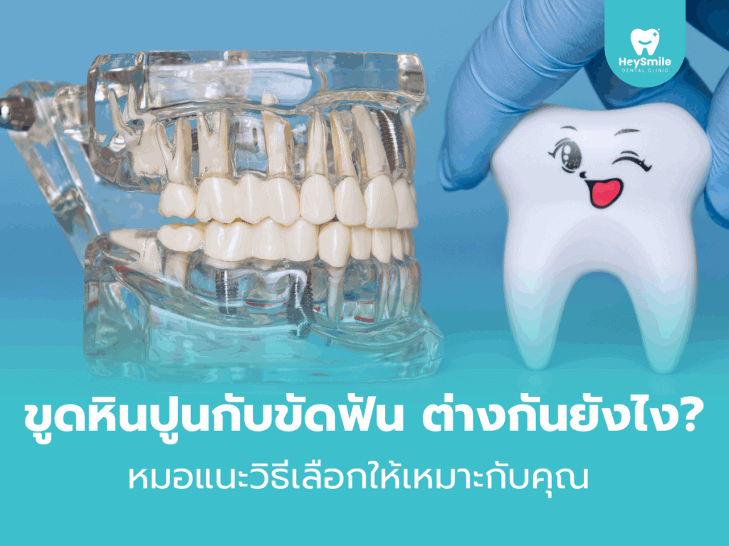 ขูดหินปูน