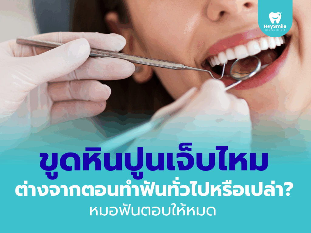 ขูดหินปูน