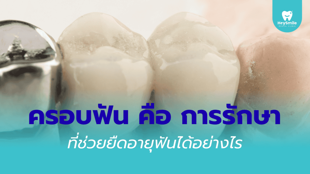 ครอบฟัน ราคา