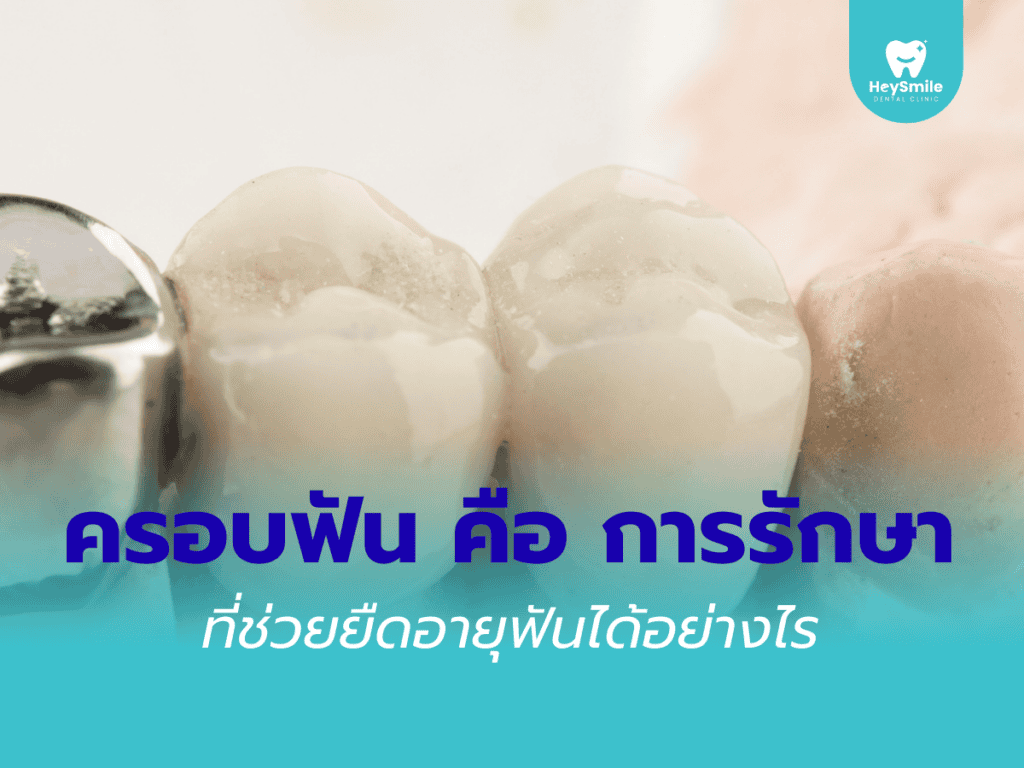 ครอบฟัน ราคา